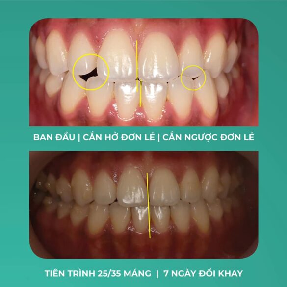 Giải quyết răng móm với chỉnh nha Invisalign
