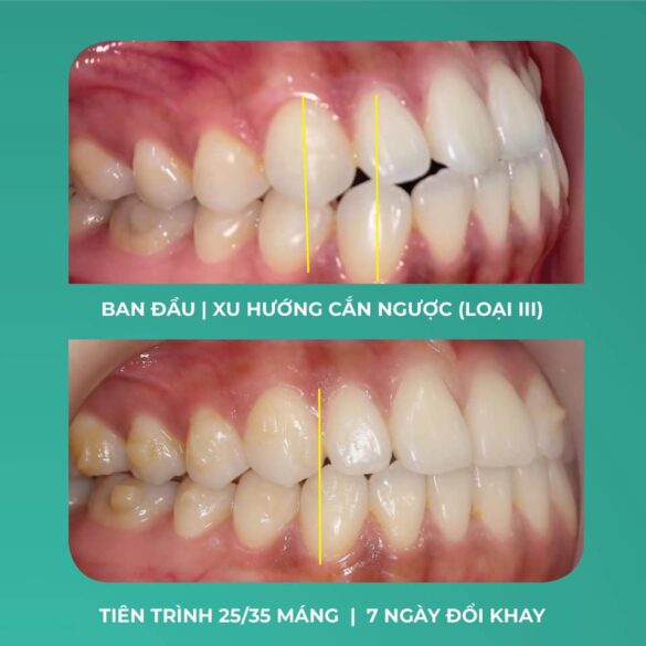 Giải quyết răng móm với chỉnh nha Invisalign
