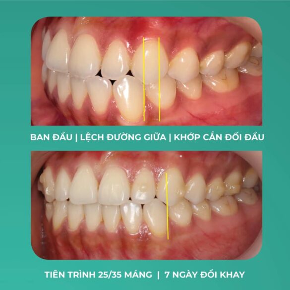 Giải quyết răng móm với chỉnh nha Invisalign