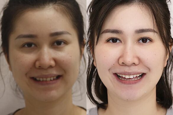 Tiến trình chỉnh nha bằng khay trong suốt