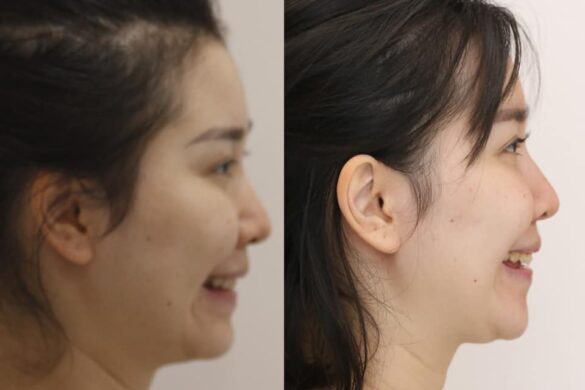 Tiến trình chỉnh nha bằng khay trong suốt
