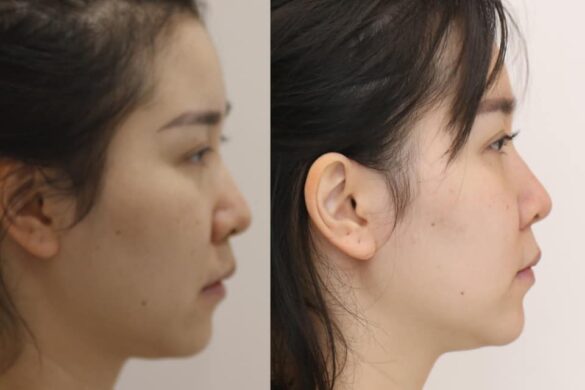 Tiến trình chỉnh nha bằng khay trong suốt