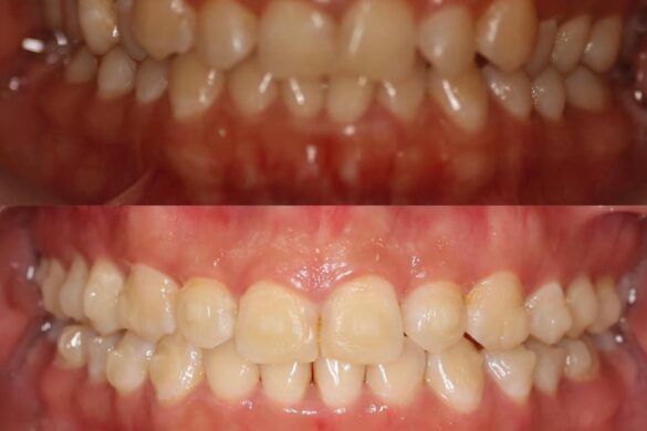 Tiến trình chỉnh nha bằng khay trong suốt