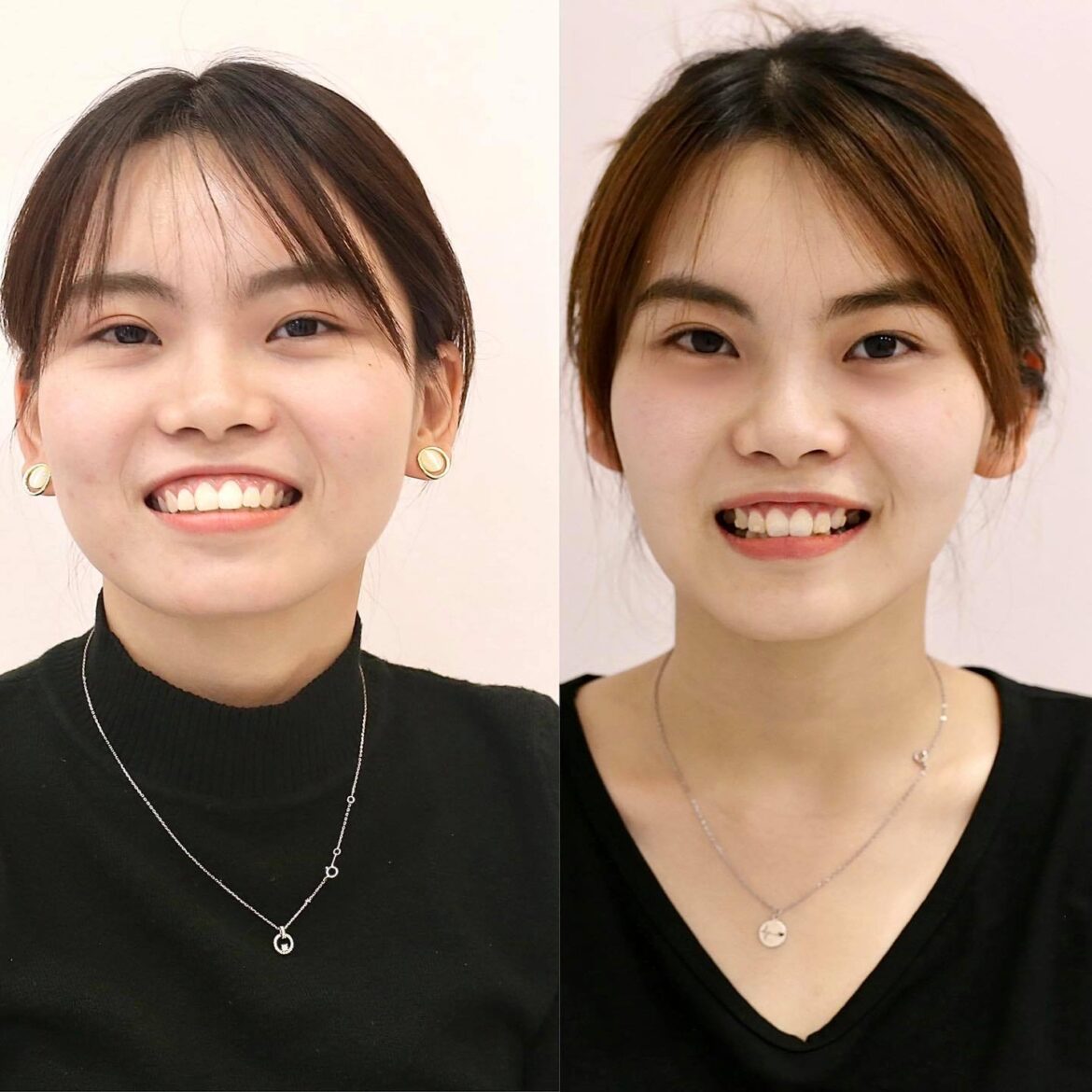 case invisalign bs Nguyen Thy Nga