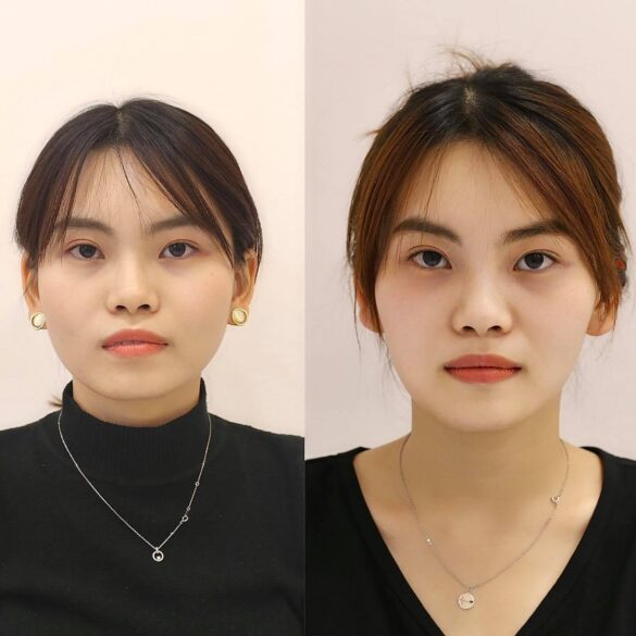 case invisalign bs Nguyen Thy Nga