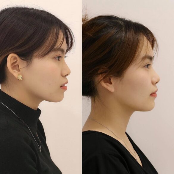 case invisalign bs Nguyen Thy Nga