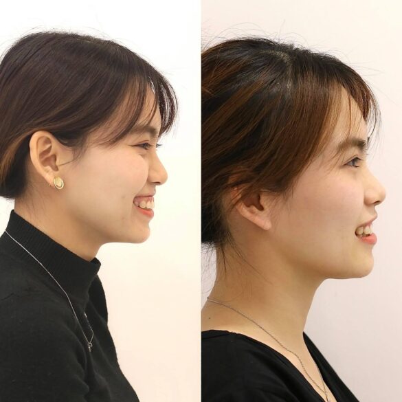 case invisalign bs Nguyen Thy Nga
