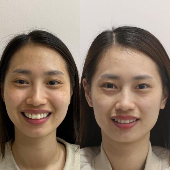 case invisalign chữa vẩu giảm hô