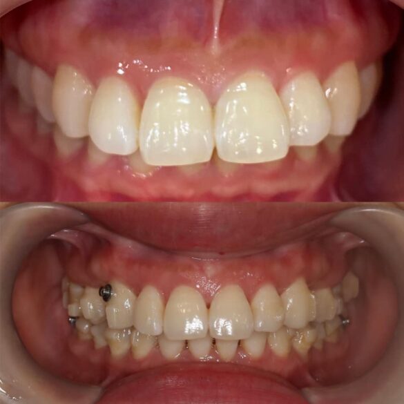 case invisalign chữa vẩu giảm hô