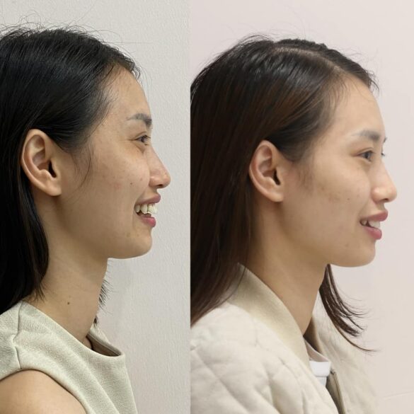 case invisalign chữa vẩu giảm hô
