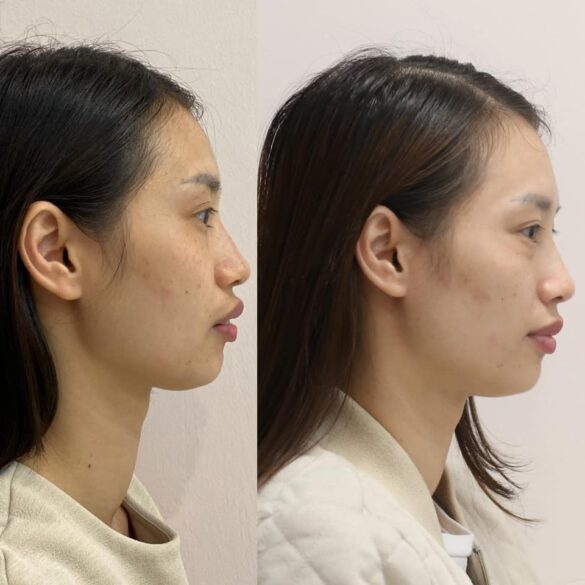 case invisalign chữa vẩu giảm hô