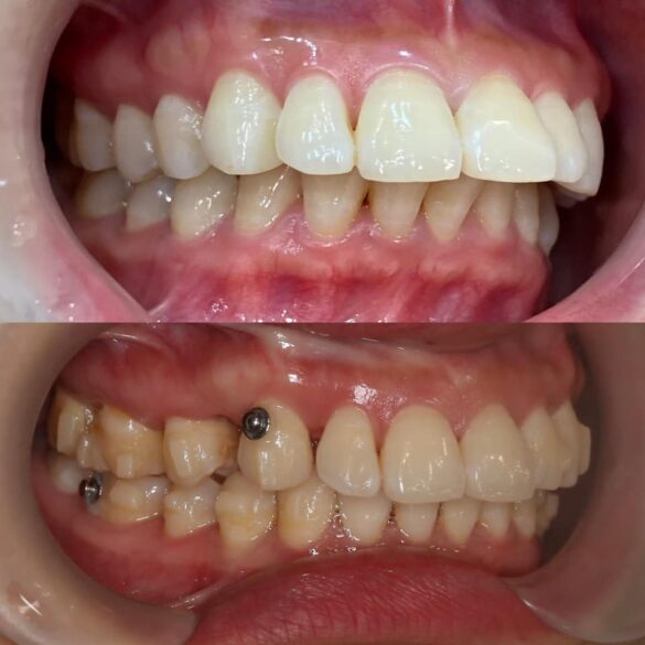 case invisalign chữa vẩu giảm hô