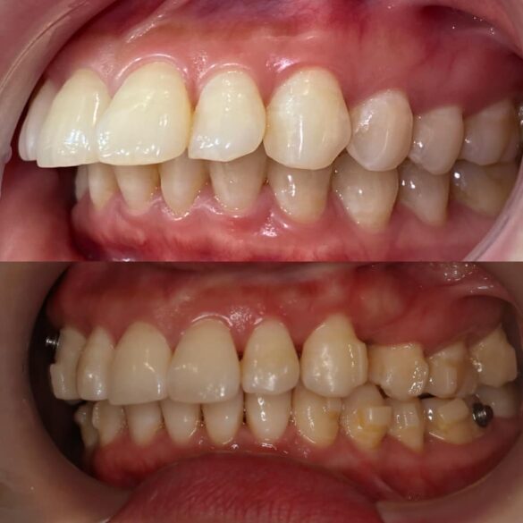 case invisalign chữa vẩu giảm hô