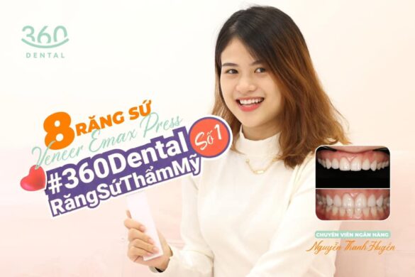 Case lâm sàng 6 mặt dán sứ veneer emax