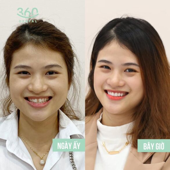 Case lâm sàng 6 mặt dán sứ veneer emax