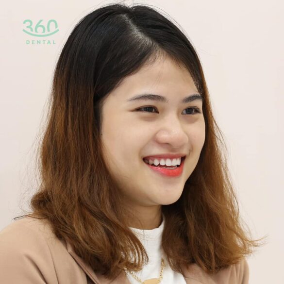 Case lâm sàng 6 mặt dán sứ veneer emax