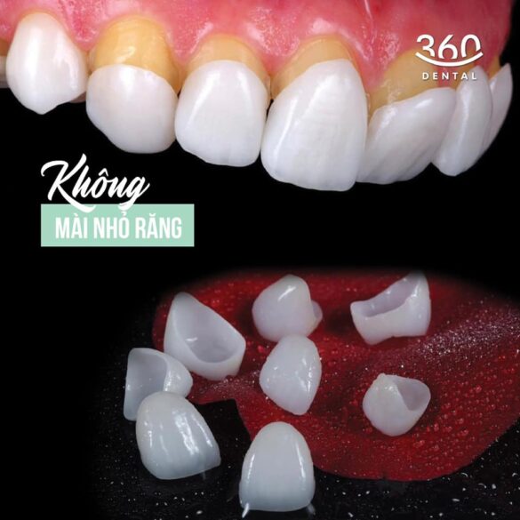 Case lâm sàng 6 mặt dán sứ veneer emax