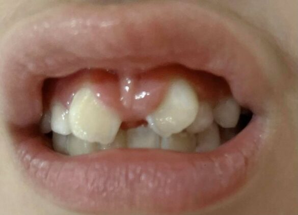 nhổ răng thừa ngầm phía trong vòm họng