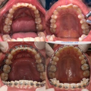 niềng răng bệnh nhân mang bầu