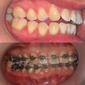 niềng răng bệnh nhân mang bầu