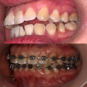 niềng răng bệnh nhân mang bầu