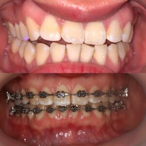 niềng răng bệnh nhân mang bầu
