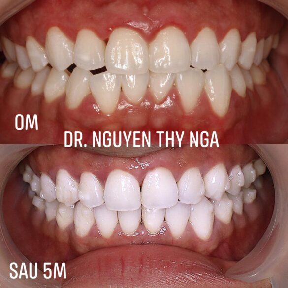 tiến trình chỉnh nha invisalign bs Thy Nga
