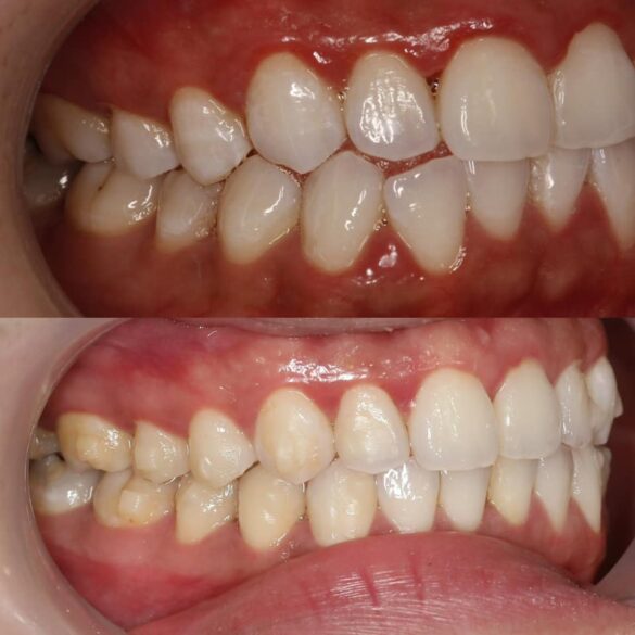 tiến trình chỉnh nha invisalign bs Thy Nga