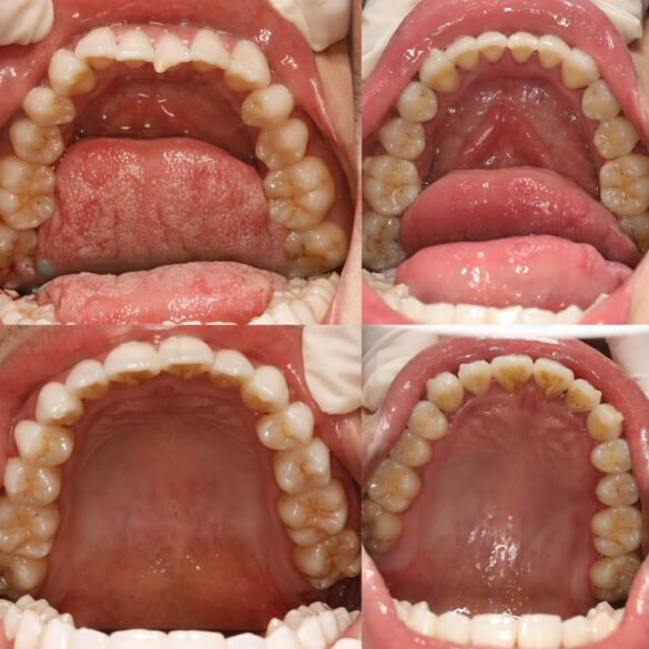 tiến trình chỉnh nha invisalign bs Thy Nga