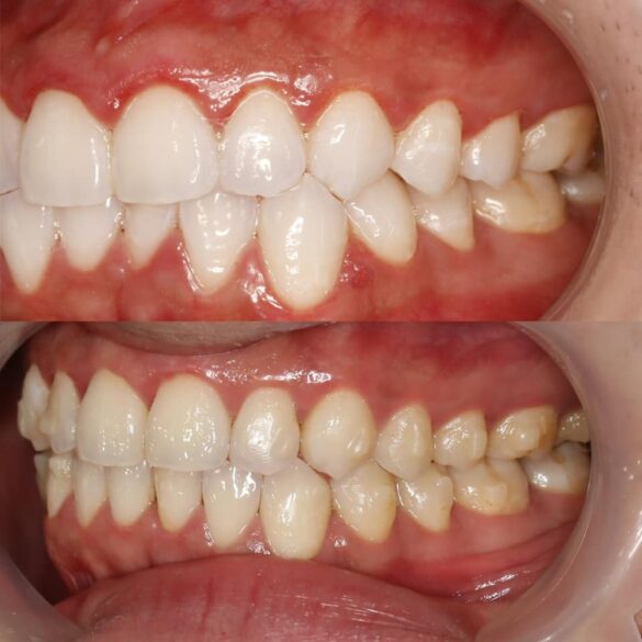 tiến trình chỉnh nha invisalign bs Thy Nga