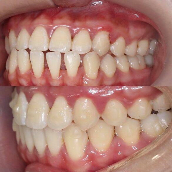 tiến trình invisalign bs Thy Nga 01