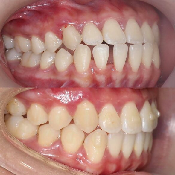 tiến trình invisalign bs Thy Nga 02