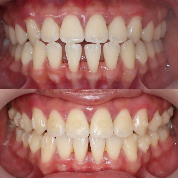 tiến trình invisalign bs Thy Nga 02