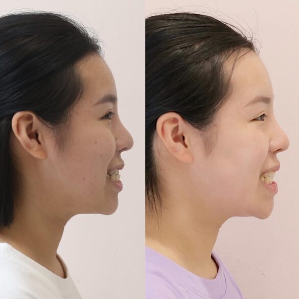 tiến trình invisalign bs Thy Nga 02