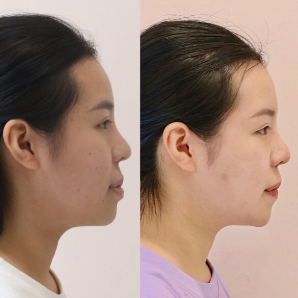 tiến trình invisalign bs Thy Nga 02