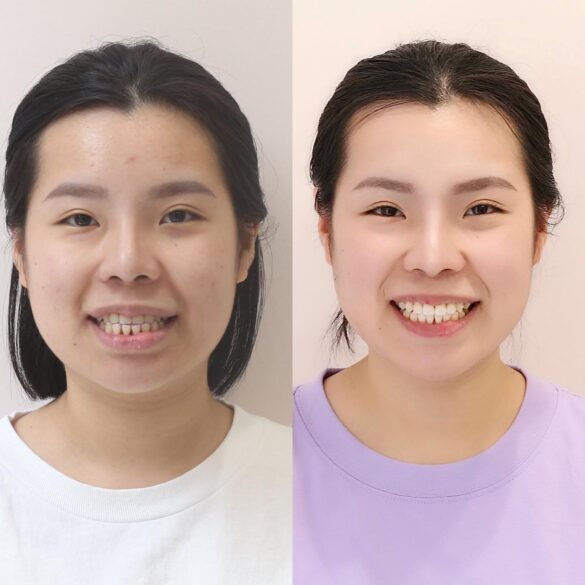 tiến trình invisalign bs Thy Nga 06